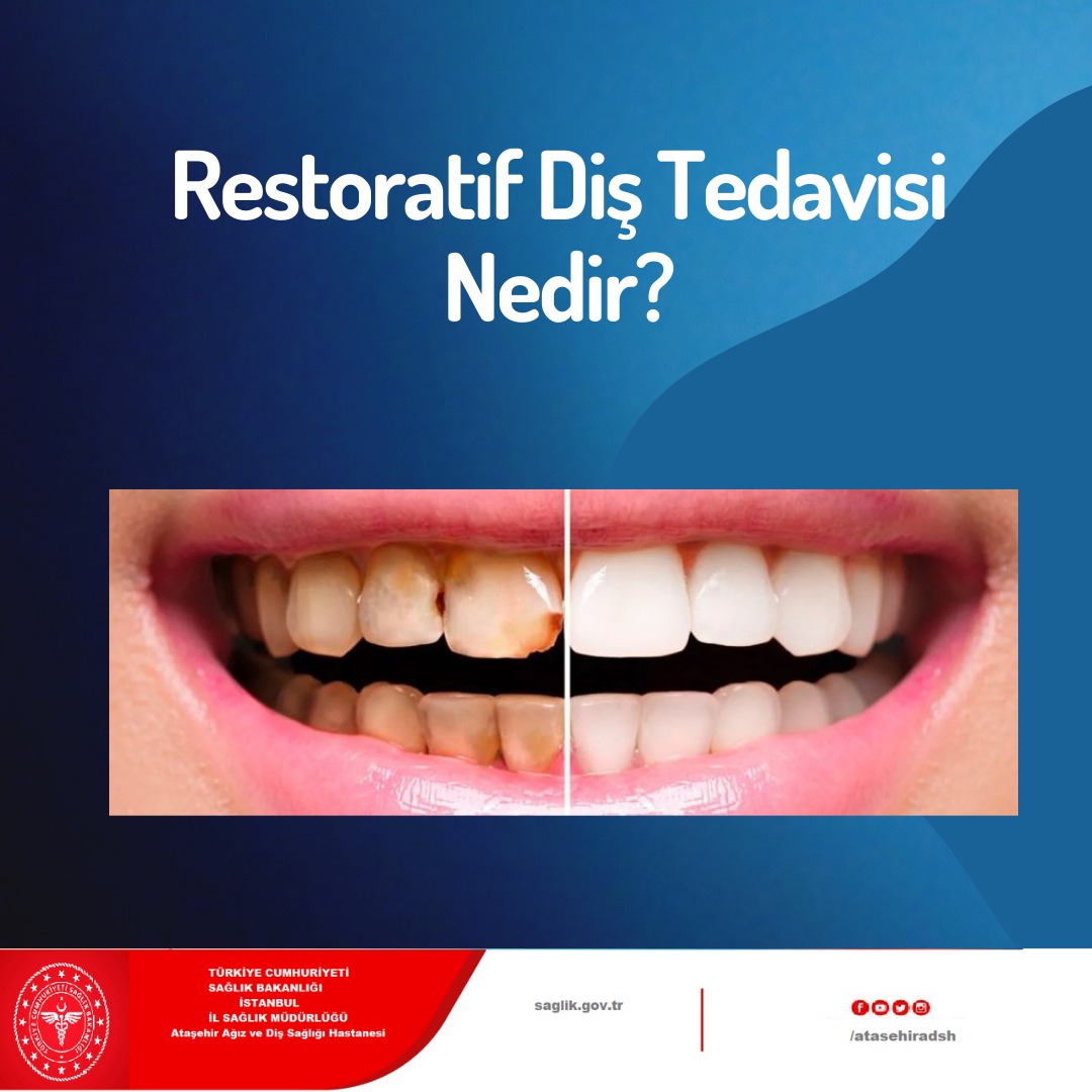 Restoratif Diş Tedavisi Nedir?