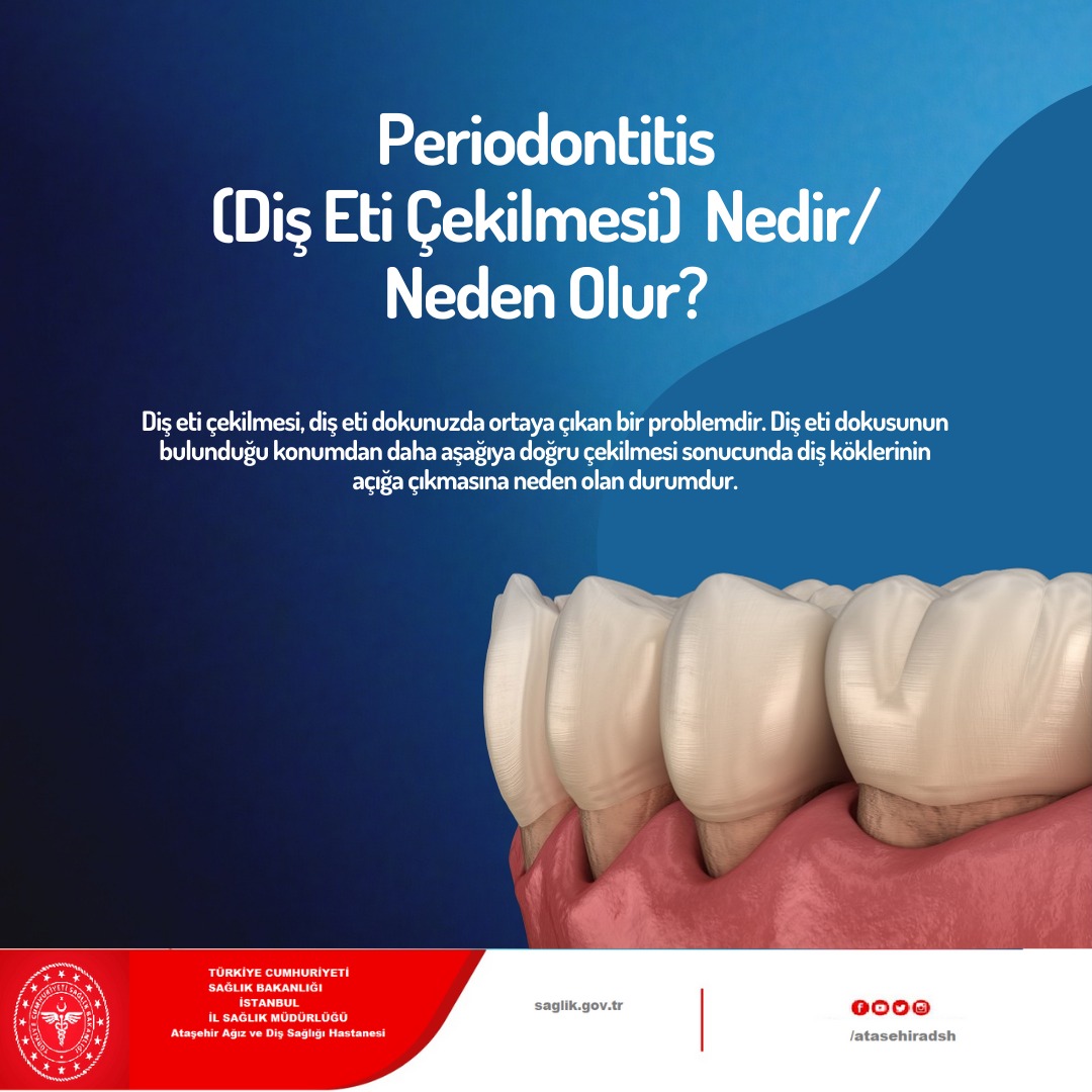 Periodontitis, Diş Eti Çekilmesine Neden Olan Ciddi Enfeksiyon