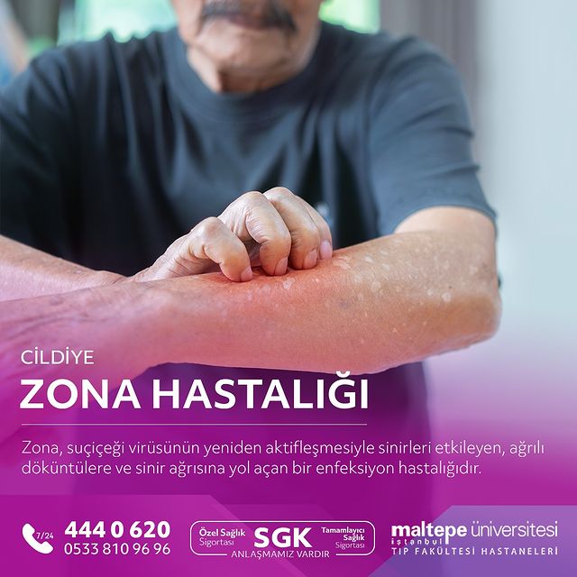 Zona Hastalığı: Belirtiler, Tedavi ve Erken Teşhis